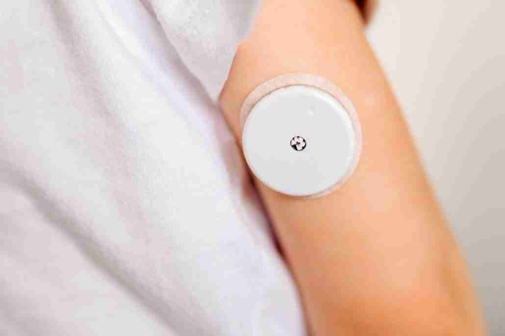 CGM -system of continuous monitoring of glucose on child's arm.